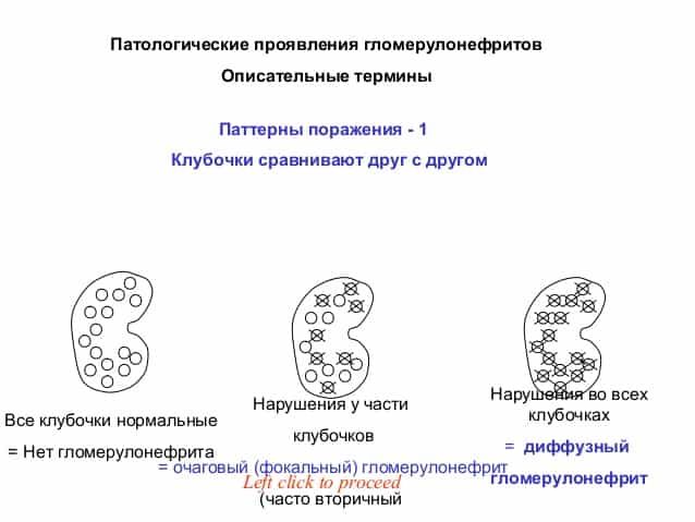 Гломерулонефрит очаговый (фокальный сегментарный гломерулярный гиалиноз)