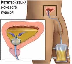 Задержка мочи