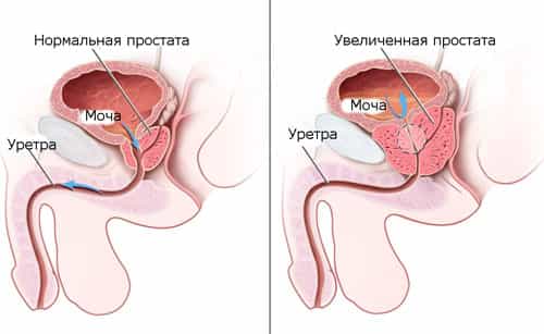 Задержка мочи