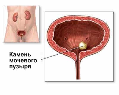 Цислоскопия камней мочевого пузыря