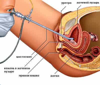 Цистоскопия камней мочевого пузыря