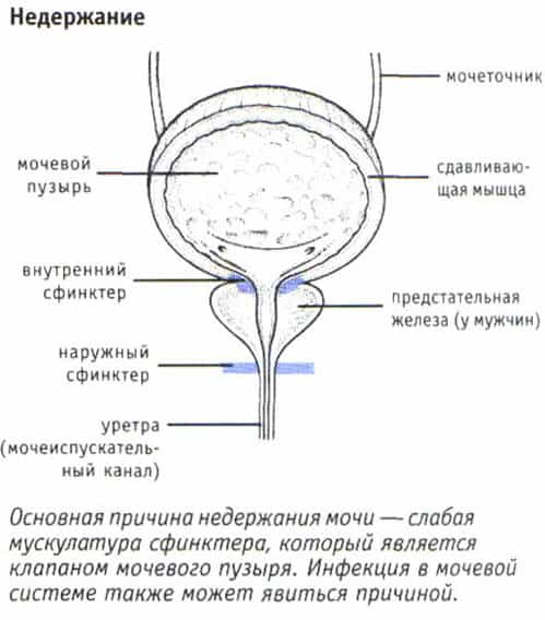 Недержание мочи (урологическое) у мужчин