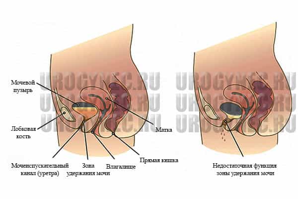 Недержание мочи (урологическое)