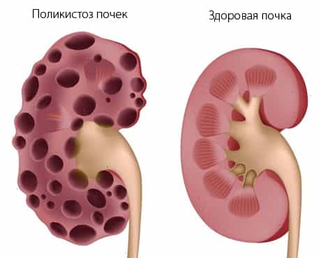 Поликистоз почек