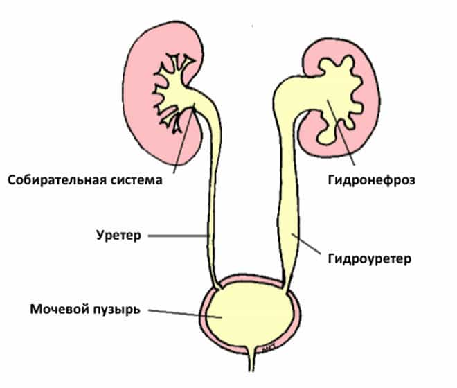 Гидронефроз