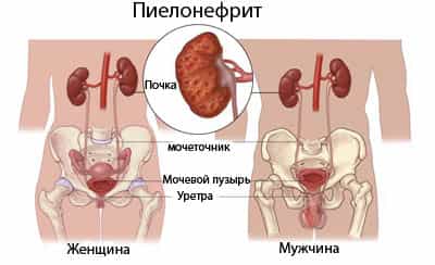 Пиелонефрит хронический