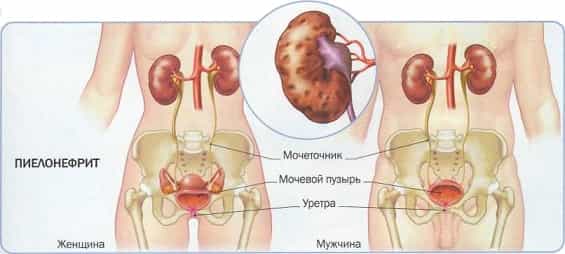 Пиелонефрит