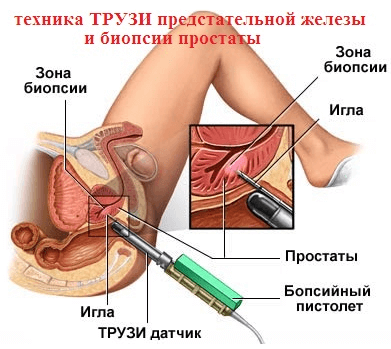 Биопсия простаты