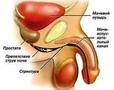 Сужение уретры