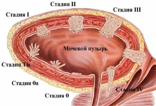 Стадии развития полипов мочевого пузыря