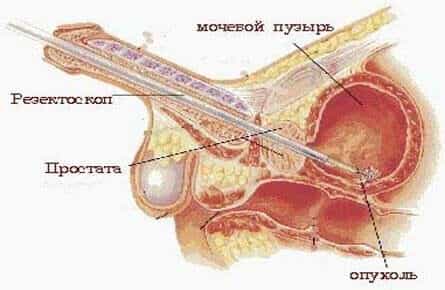 Опухоль в мочевике