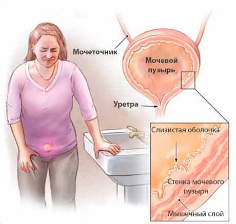 Папилломавирусная инфекция мочеполового тракта