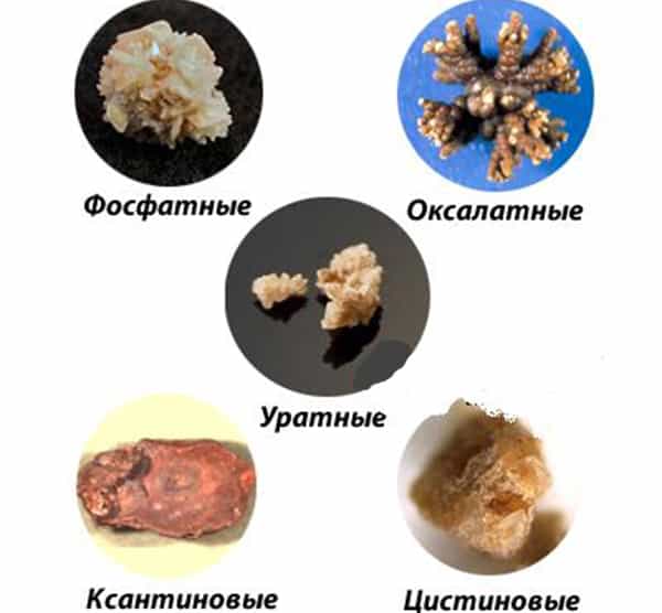 Почечнокаменная болезнь