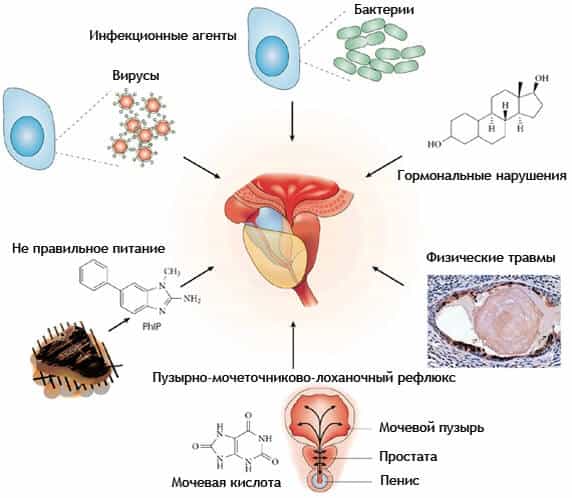 Возбудители простатита