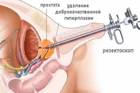 Удаление доброкачественное гиперплазии простаты