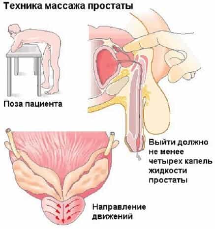 Техника массажа простаты