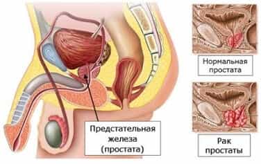 Аденома простаты