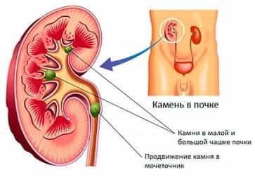 Камень в почках