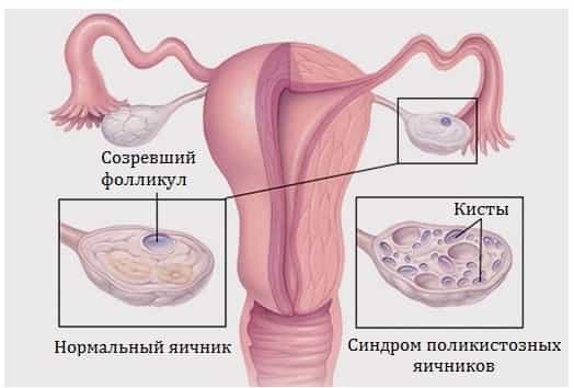 Поликистоз яичника