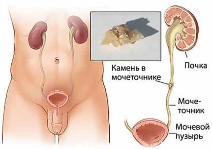 Мочекаменная болезнь