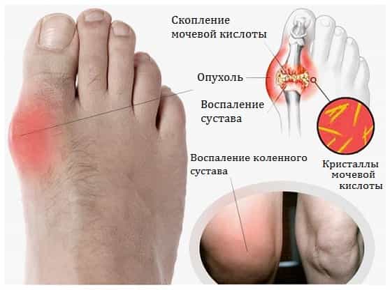 Подагра суставов