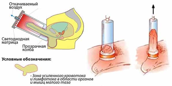 Лечебные процедуры для улучшения эрекции