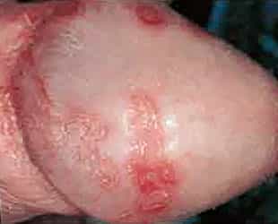 Куперит (воспаление бульбоуретральных желез в мочеиспускательном канале у мужчин) в следствии хламидиоза