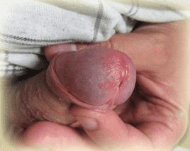 Куперит (воспаление бульбоуретральных желез в мочеиспускательном канале у мужчин) в следствии урагенного трихомониаза