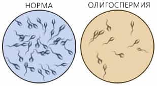 Олигозооспермия