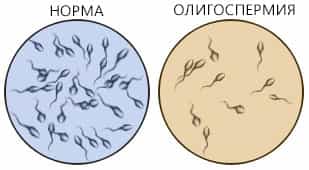 Олигозооспермия