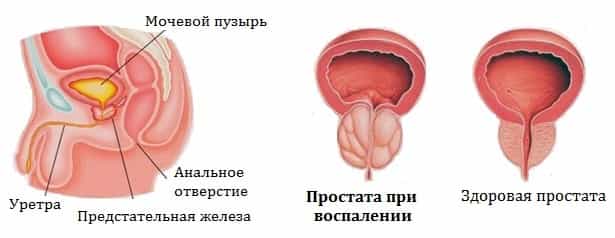 Воспаление предстательной железы