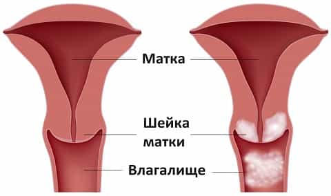 Рак влагалища