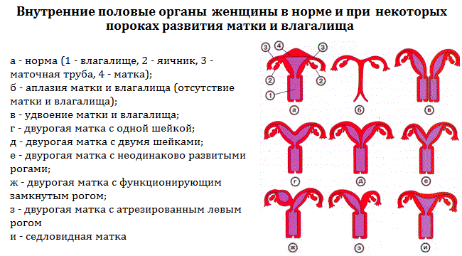 Аномалии развития половых органов