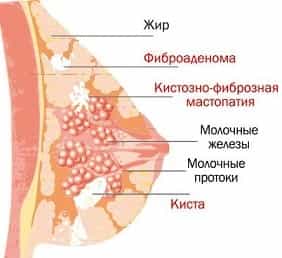 Диффузная мастопатия