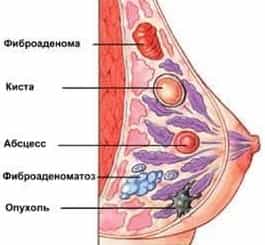 Формы мастопатии