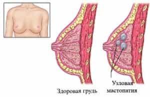 Узловая мастопатия