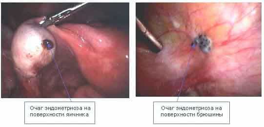 Внутренний эндометриоз