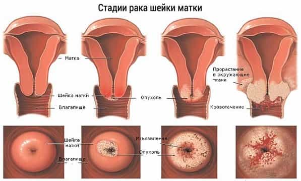 Стадии эрозии шейки матки