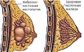 Фиброзно-кистозная мастопатия