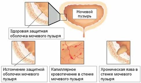 Воспаление мочевого пузыря