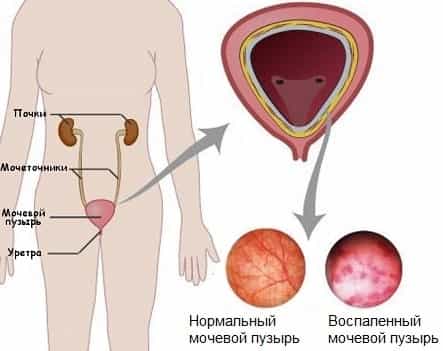 Цистит