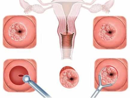 Диагностика эрозии шейки матки