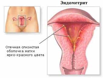 Эндометрит шейки матки