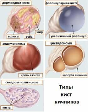 Виды кист яичников