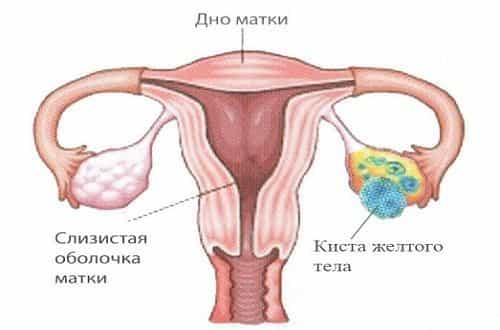 Киста желтого тела яичника