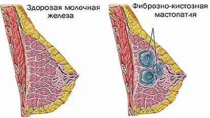 Фиброзно-кистозная мастопатия