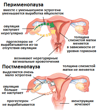 Менопауза