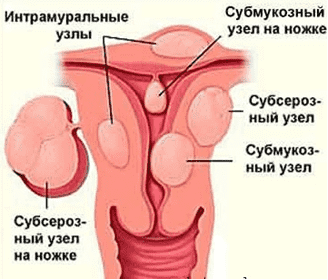 Миома. Субсерозные узлы