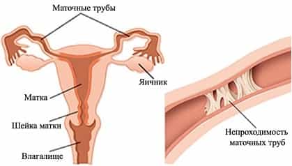 Непроходимость маточных труб