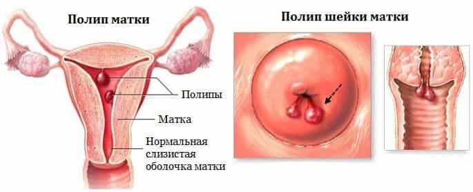 Полип матки